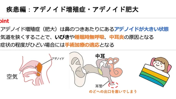 アデノイド増殖症・アデノイド肥大