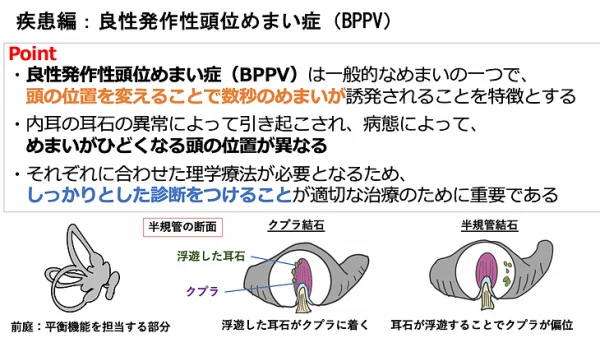 良性発作性頭位めまい症（BPPV）