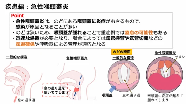 急性喉頭蓋炎