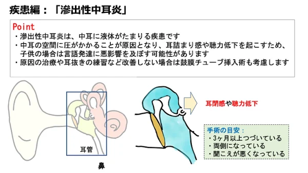 滲出性中耳炎