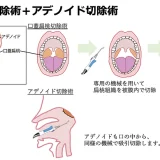 被膜内口蓋扁桃切除術、アデノイド切除術