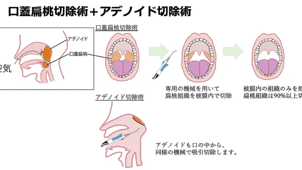 被膜内口蓋扁桃切除術、アデノイド切除術