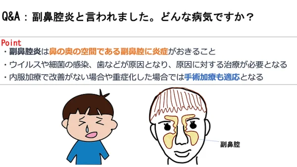 副鼻腔炎と言われました。どんな病気ですか？