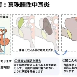 鼓室形成術（真珠腫性中耳炎）