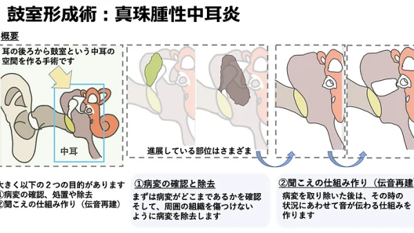 鼓室形成術（真珠腫性中耳炎）