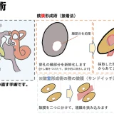 鼓膜形成術