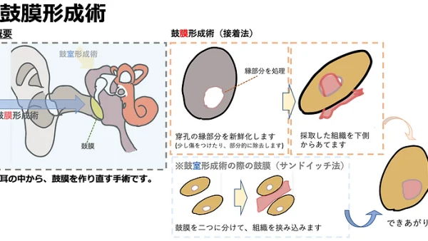 鼓膜形成術