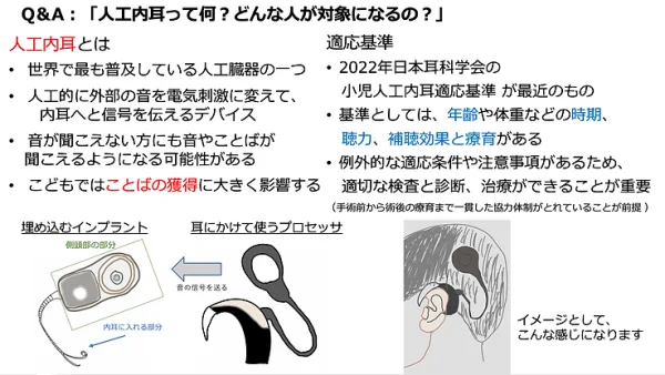 人工内耳って何？どんな人が対象になるの？