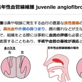 若年性血管線維腫