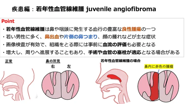 若年性血管線維腫