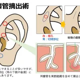 耳瘻管摘出術