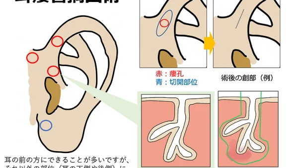 耳瘻管摘出術