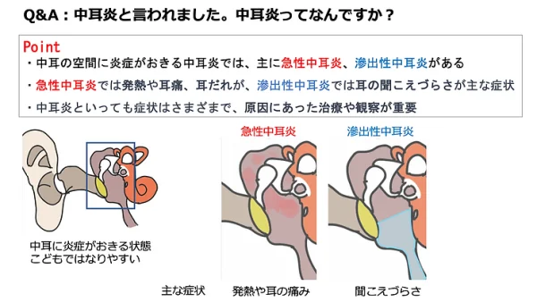 中耳炎と言われました。中耳炎ってなんですか？