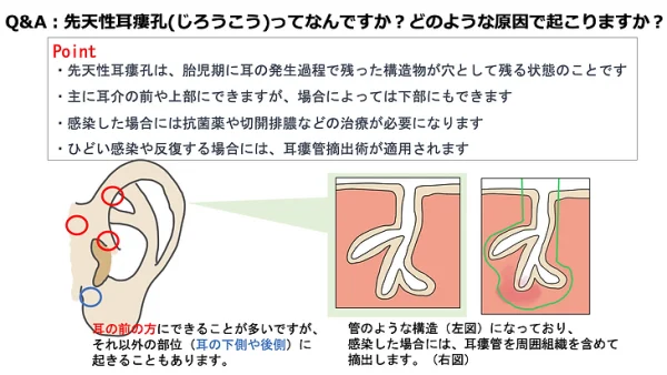 先天性耳瘻孔(じろうこう)ってなんですか？どのような原因で起こりますか？