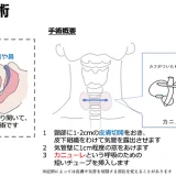 気管切開術