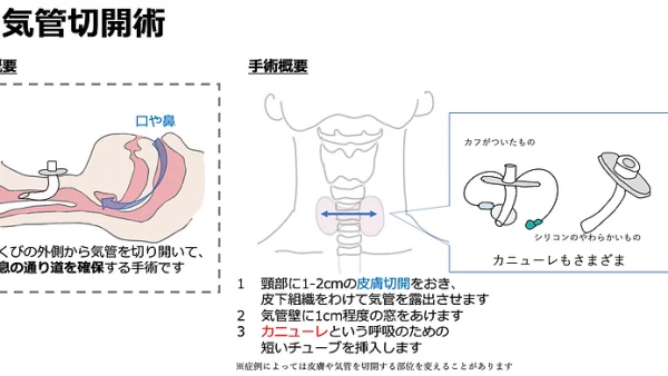 気管切開術