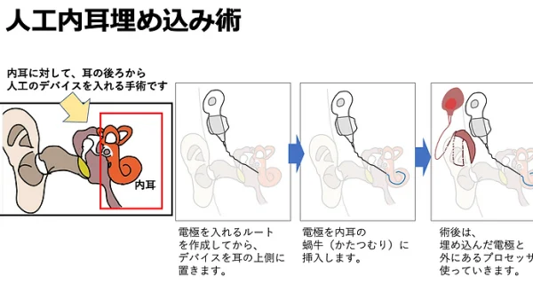 人工内耳埋め込み術