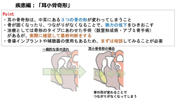 耳小骨奇形