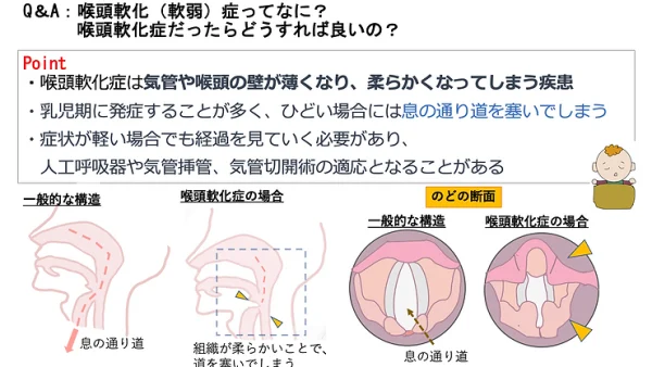 喉頭軟化症ってなに？こどもが喉頭軟化症だったらどうすれば良いの？