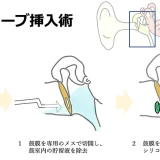 鼓膜チューブ挿入術