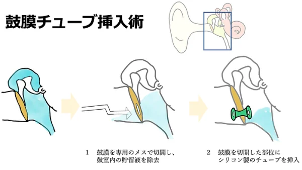 鼓膜チューブ挿入術