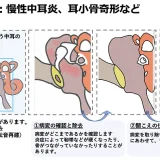 鼓室形成術（慢性中耳炎や耳小骨奇形など）