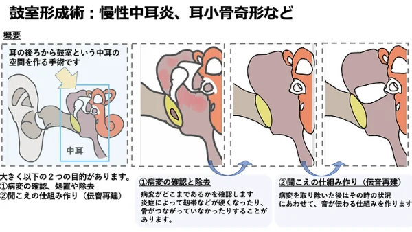 鼓室形成術（慢性中耳炎や耳小骨奇形など）