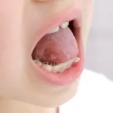 舌小帯短縮症（ぜつしょうたいたんしゅくしょう）について